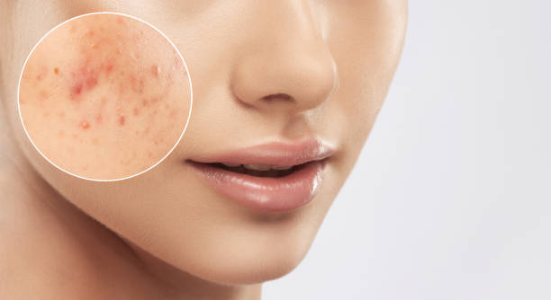 A young girl with a problem skin. Photo before and after treatment for acne.