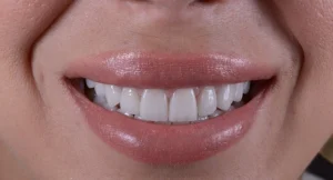 veneer teeth singapore