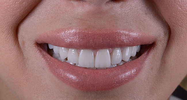 veneer teeth singapore